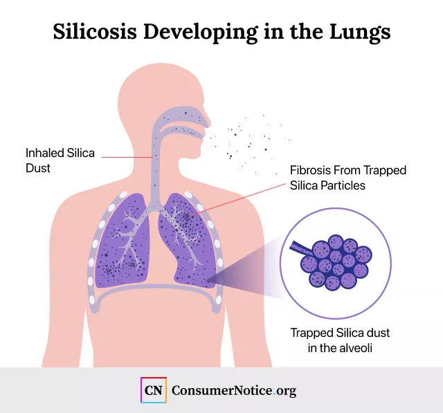 Silicosis Silicosis Graph